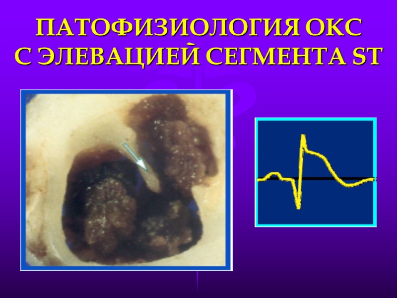 ПАТОФИЗИОЛОГИЯ ОКС        С ЭЛЕВАЦИЕЙ СЕГМЕНТА ST